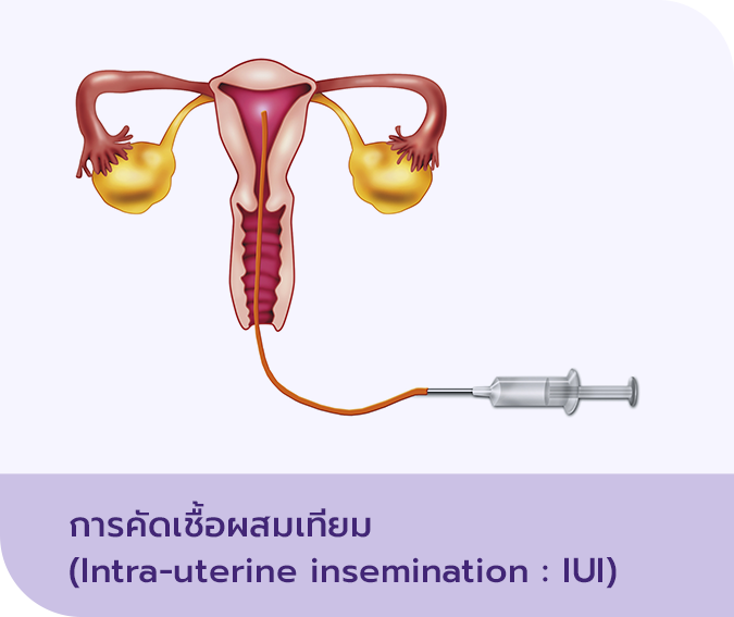 การฉีดอสุจิผสมเทียม (Intrauterine insemination หรือ IUI)
